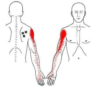 Trigger Point Therapy Burnaby Physio
