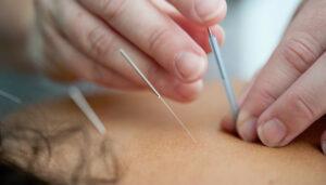 What Else Does Acupuncture Help You With?