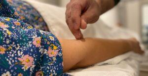 Physiotherapists Who Do Acupuncture